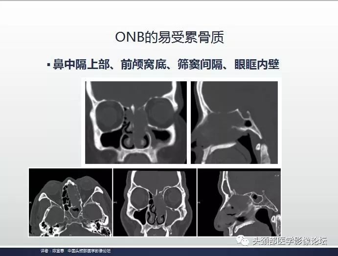 影像PPT - 嗅神经母细胞瘤影像学诊断分析思路-6