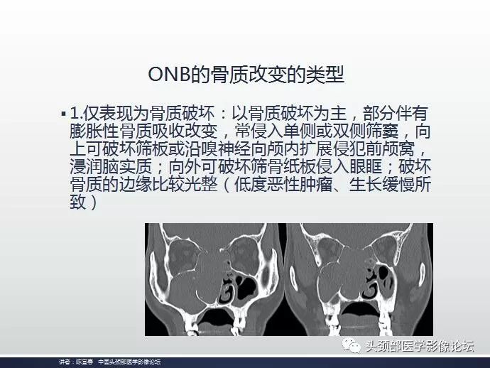 影像PPT - 嗅神经母细胞瘤影像学诊断分析思路-7