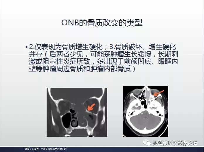 影像PPT - 嗅神经母细胞瘤影像学诊断分析思路-8