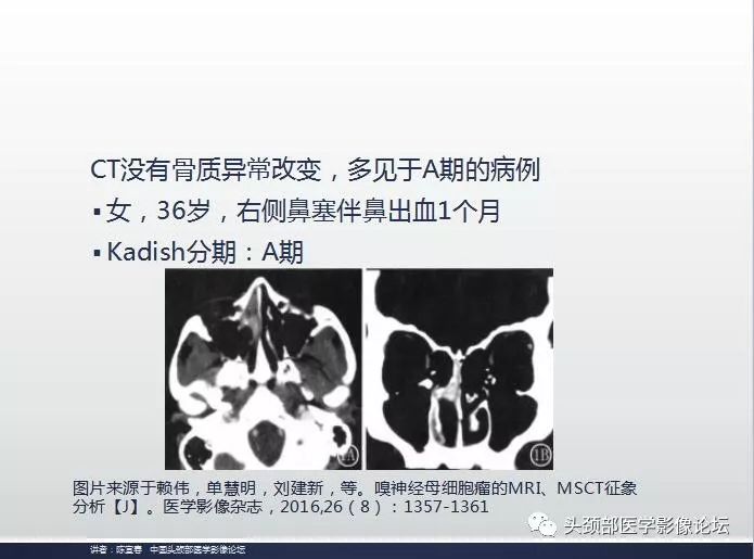影像PPT - 嗅神经母细胞瘤影像学诊断分析思路-9