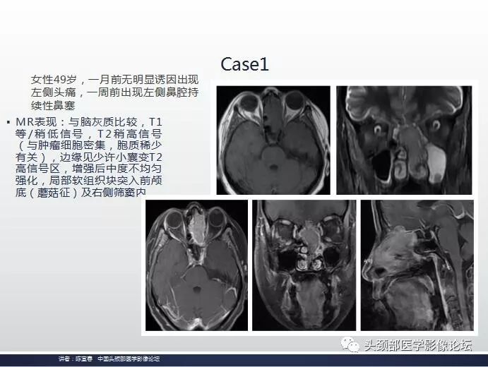 影像PPT - 嗅神经母细胞瘤影像学诊断分析思路-11