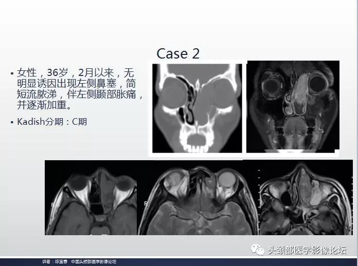 影像PPT - 嗅神经母细胞瘤影像学诊断分析思路-12