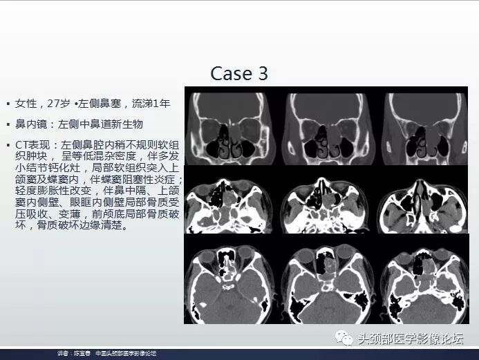 影像PPT - 嗅神经母细胞瘤影像学诊断分析思路-13