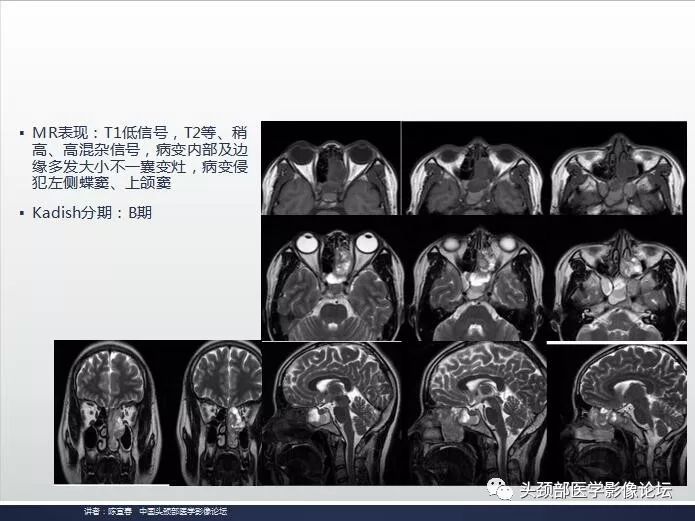 影像PPT - 嗅神经母细胞瘤影像学诊断分析思路-14