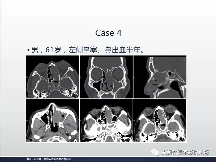 影像PPT - 嗅神经母细胞瘤影像学诊断分析思路-15
