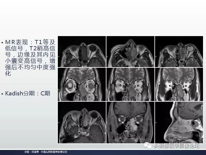 影像PPT - 嗅神经母细胞瘤影像学诊断分析思路-16