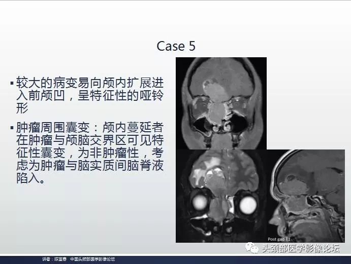 影像PPT - 嗅神经母细胞瘤影像学诊断分析思路-17