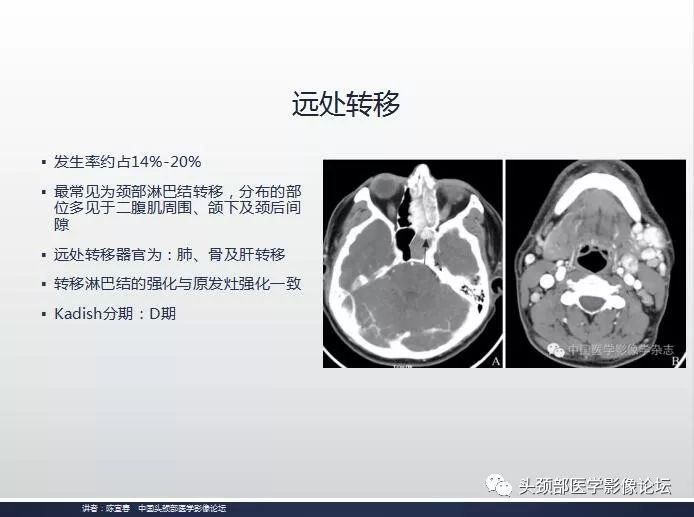 影像PPT - 嗅神经母细胞瘤影像学诊断分析思路-18