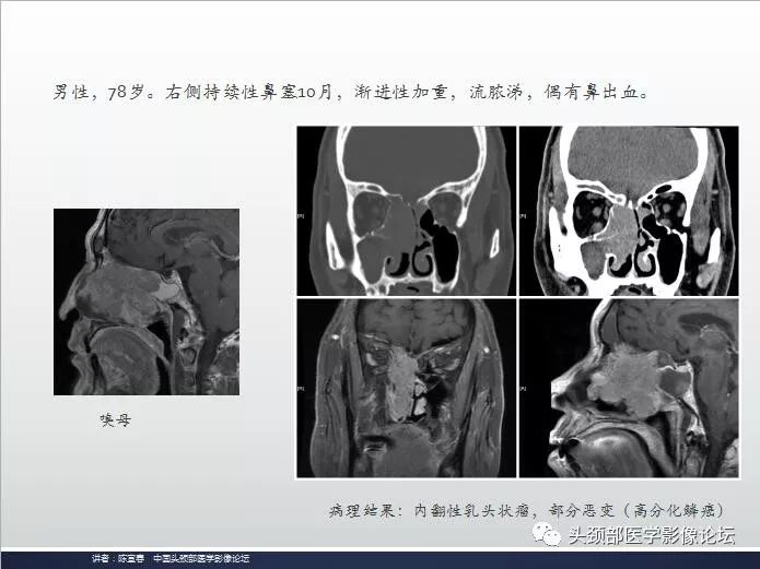 影像PPT - 嗅神经母细胞瘤影像学诊断分析思路-20