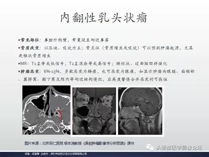 影像PPT - 嗅神经母细胞瘤影像学诊断分析思路-21