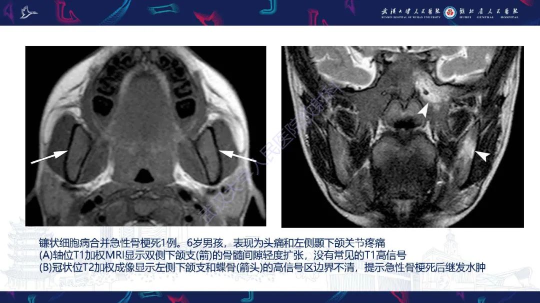 影像PPT - 【PPT】累及颅面部的系统性疾病影像诊断-7