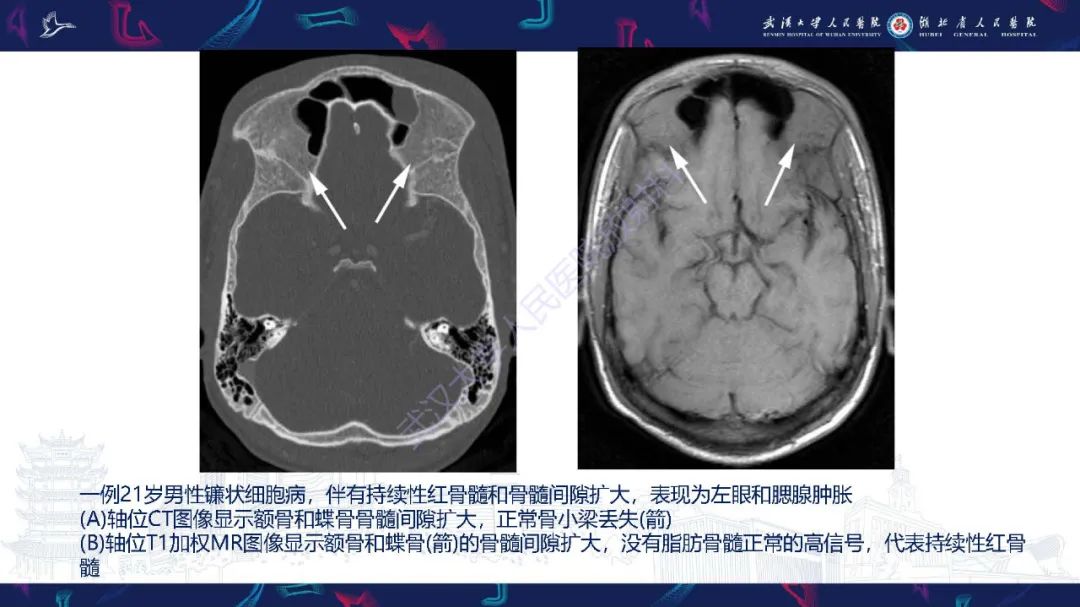 影像PPT - 【PPT】累及颅面部的系统性疾病影像诊断-10