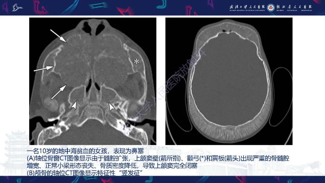影像PPT - 【PPT】累及颅面部的系统性疾病影像诊断-13