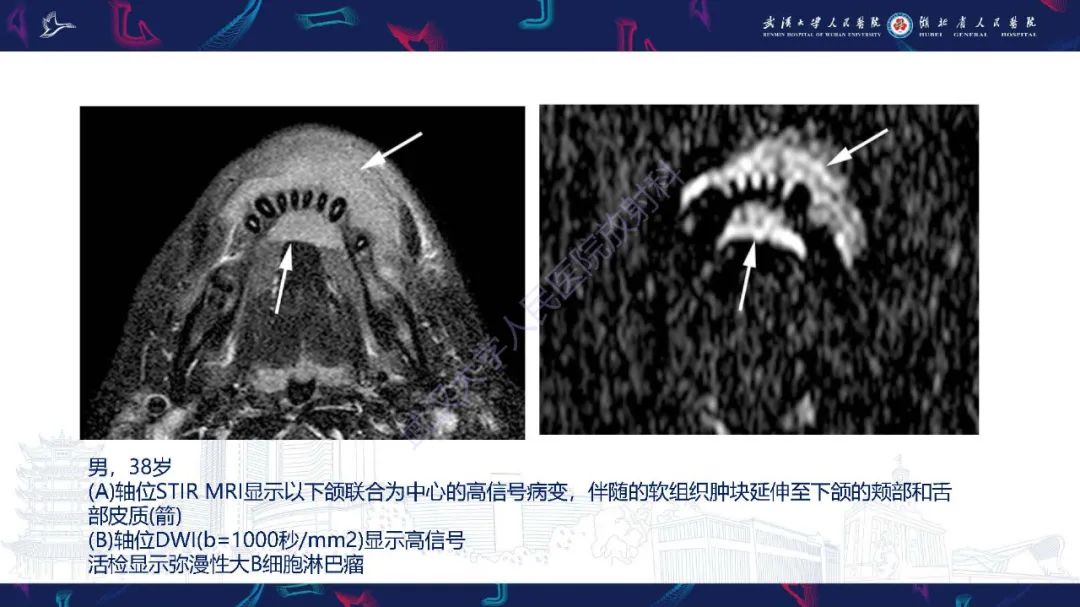 影像PPT - 【PPT】累及颅面部的系统性疾病影像诊断-17