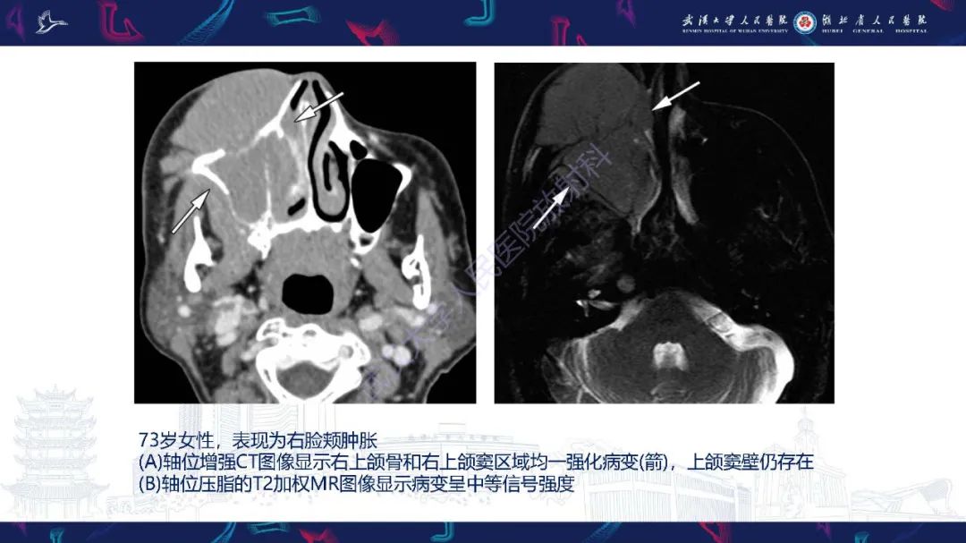 影像PPT - 【PPT】累及颅面部的系统性疾病影像诊断-18
