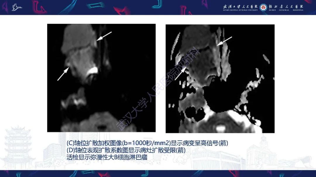 影像PPT - 【PPT】累及颅面部的系统性疾病影像诊断-19