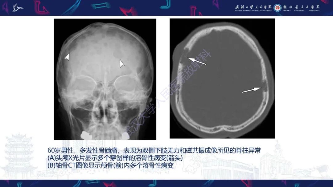影像PPT - 【PPT】累及颅面部的系统性疾病影像诊断-22