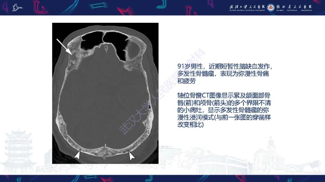 影像PPT - 【PPT】累及颅面部的系统性疾病影像诊断-23