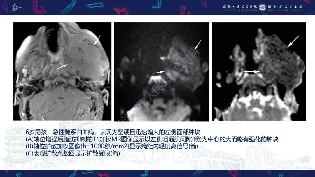 影像PPT - 【PPT】累及颅面部的系统性疾病影像诊断-27