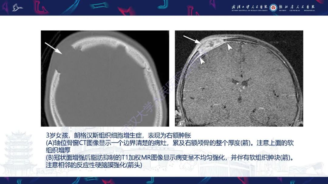 影像PPT - 【PPT】累及颅面部的系统性疾病影像诊断-31
