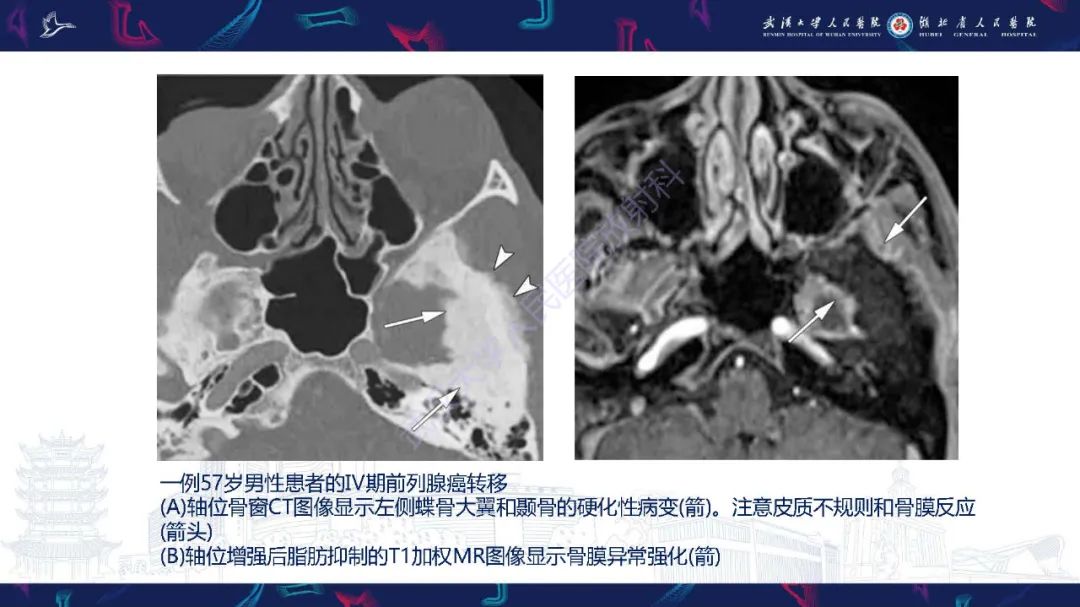 影像PPT - 【PPT】累及颅面部的系统性疾病影像诊断-34