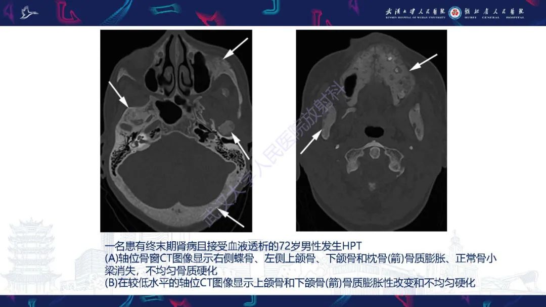影像PPT - 【PPT】累及颅面部的系统性疾病影像诊断-44