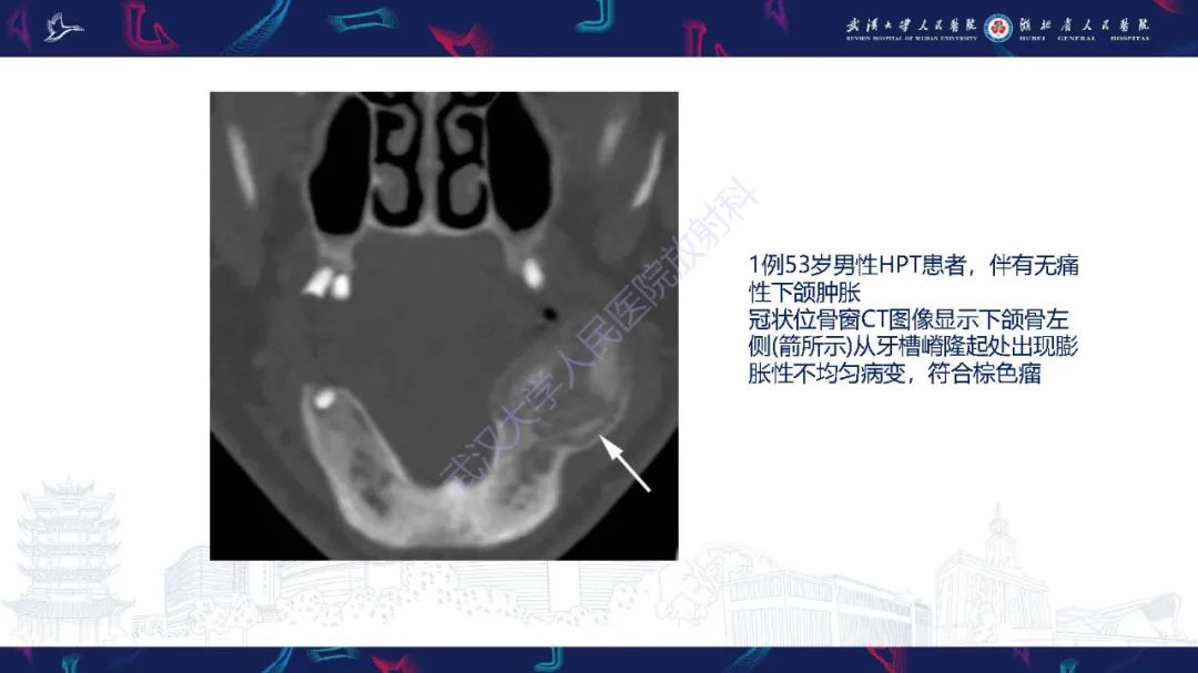 影像PPT - 【PPT】累及颅面部的系统性疾病影像诊断-46