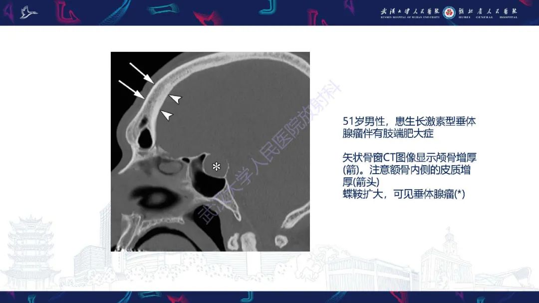 影像PPT - 【PPT】累及颅面部的系统性疾病影像诊断-48