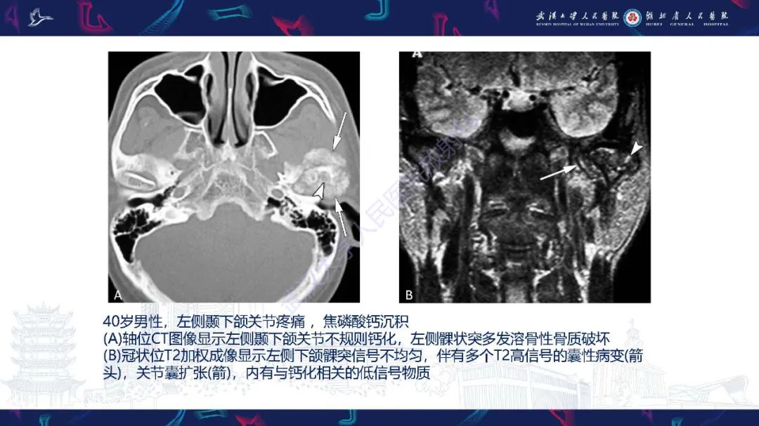 影像PPT - 【PPT】累及颅面部的系统性疾病影像诊断-51
