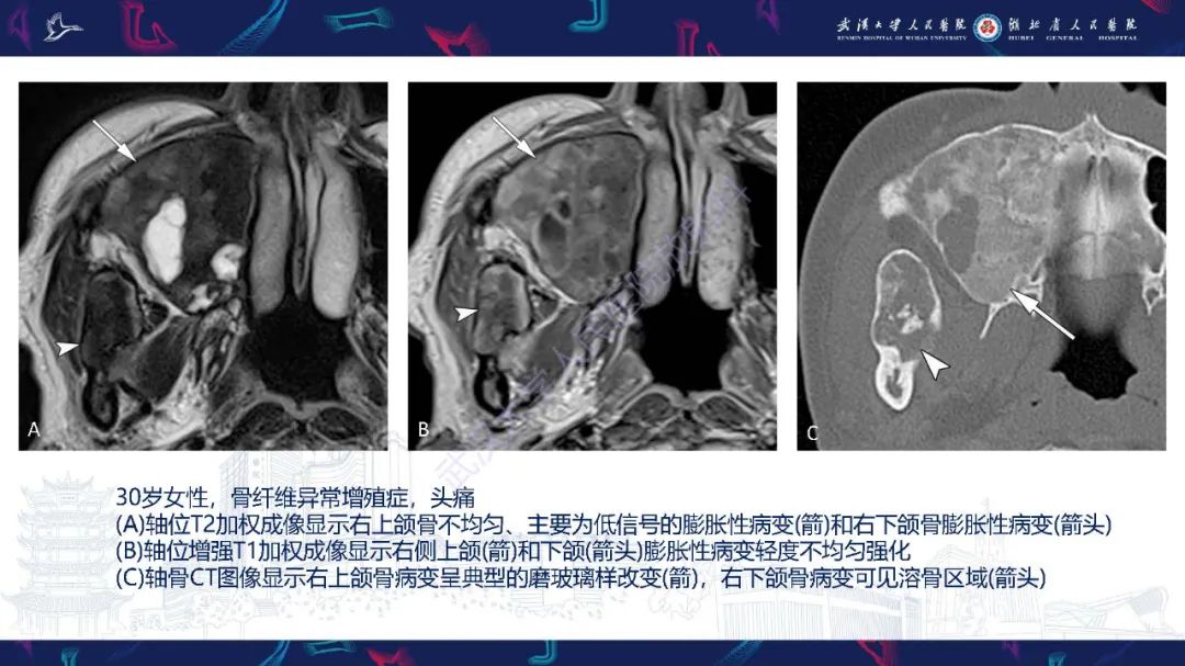 影像PPT - 【PPT】累及颅面部的系统性疾病影像诊断-56
