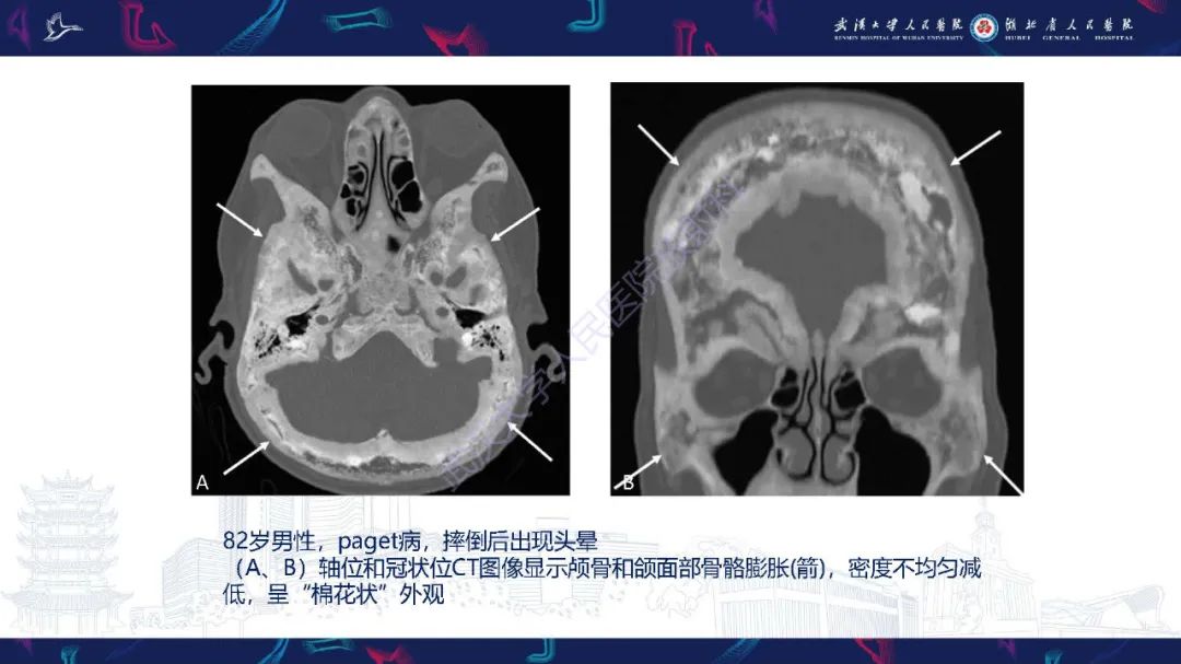 影像PPT - 【PPT】累及颅面部的系统性疾病影像诊断-60