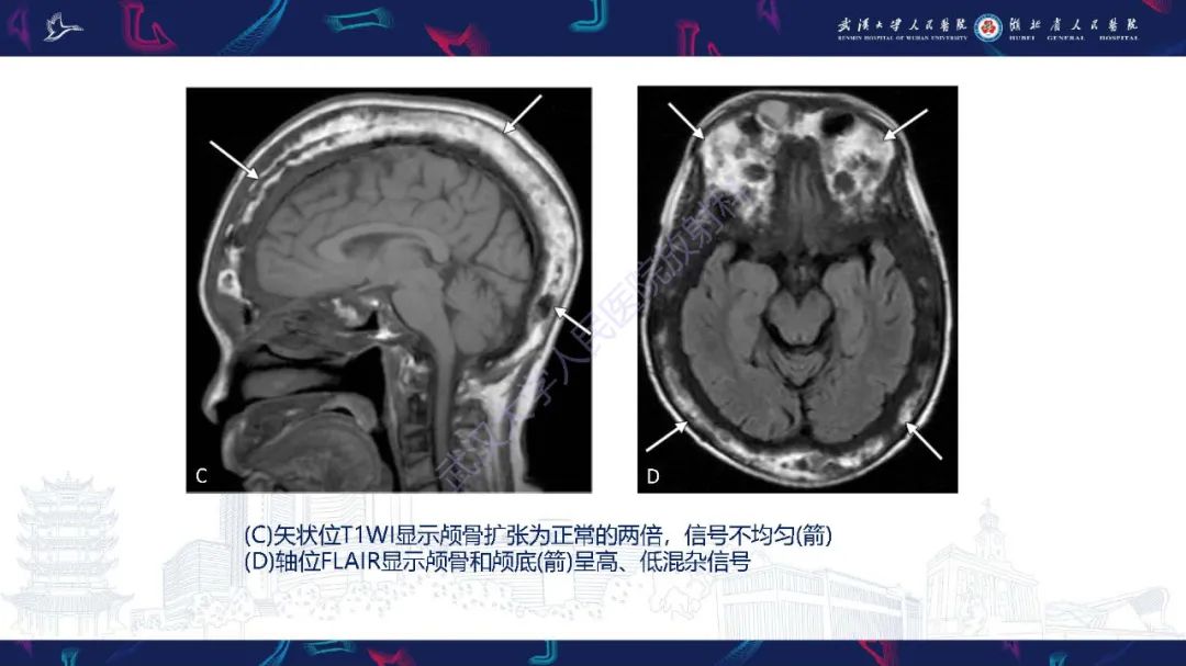 影像PPT - 【PPT】累及颅面部的系统性疾病影像诊断-61