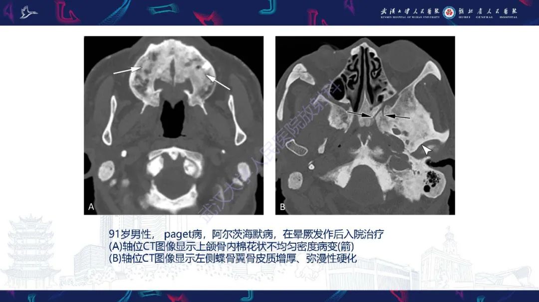 影像PPT - 【PPT】累及颅面部的系统性疾病影像诊断-62