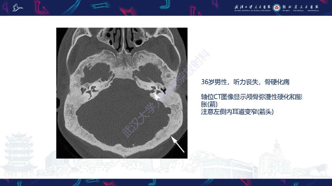 影像PPT - 【PPT】累及颅面部的系统性疾病影像诊断-65