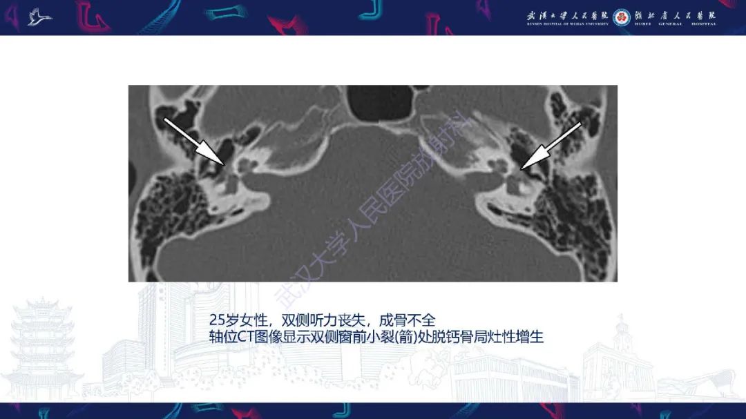 影像PPT - 【PPT】累及颅面部的系统性疾病影像诊断-67