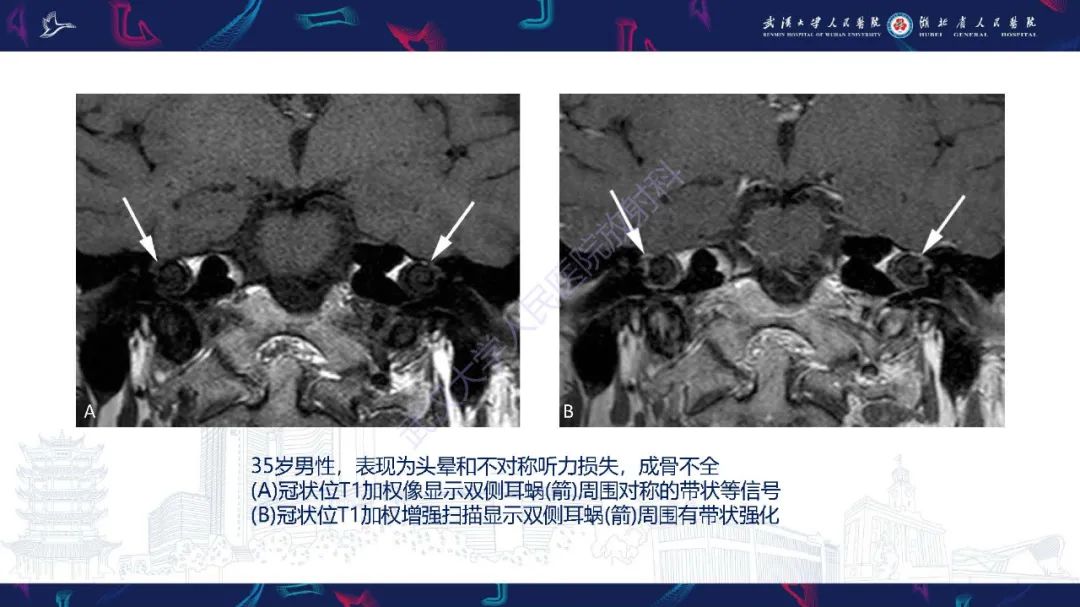 影像PPT - 【PPT】累及颅面部的系统性疾病影像诊断-68