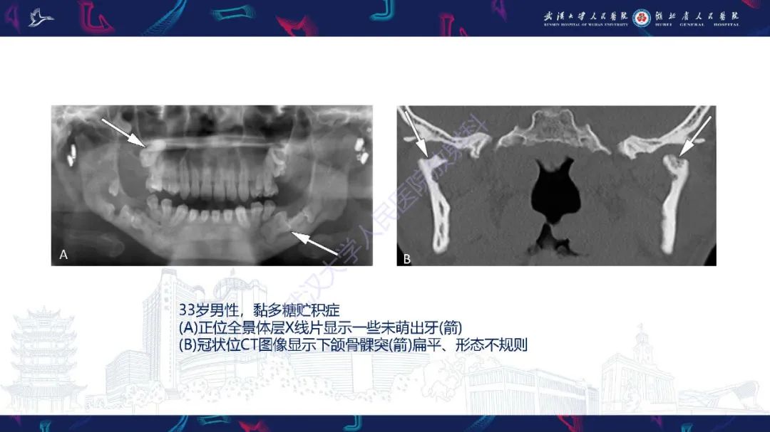 影像PPT - 【PPT】累及颅面部的系统性疾病影像诊断-71