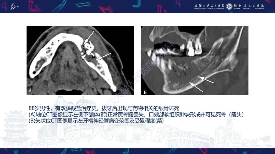 影像PPT - 【PPT】累及颅面部的系统性疾病影像诊断-75