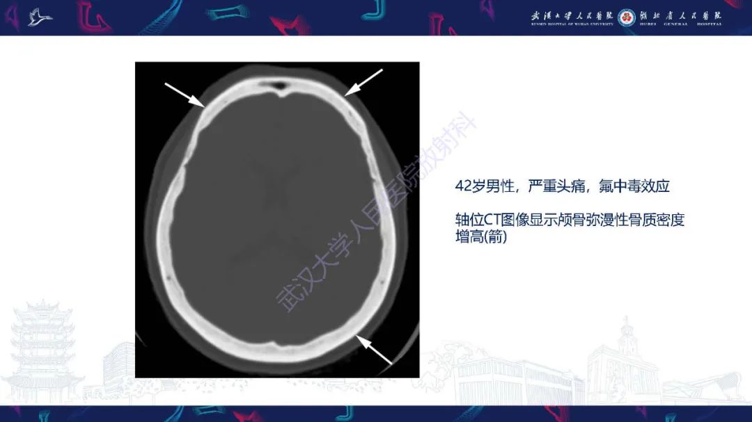 影像PPT - 【PPT】累及颅面部的系统性疾病影像诊断-77