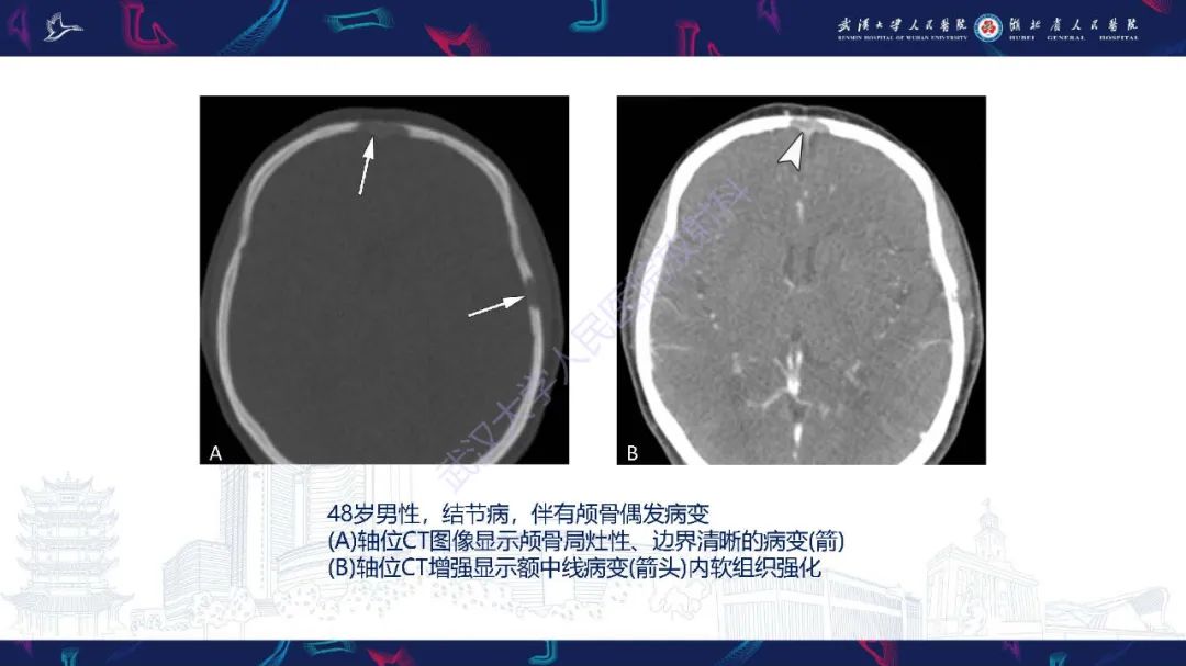 影像PPT - 【PPT】累及颅面部的系统性疾病影像诊断-81