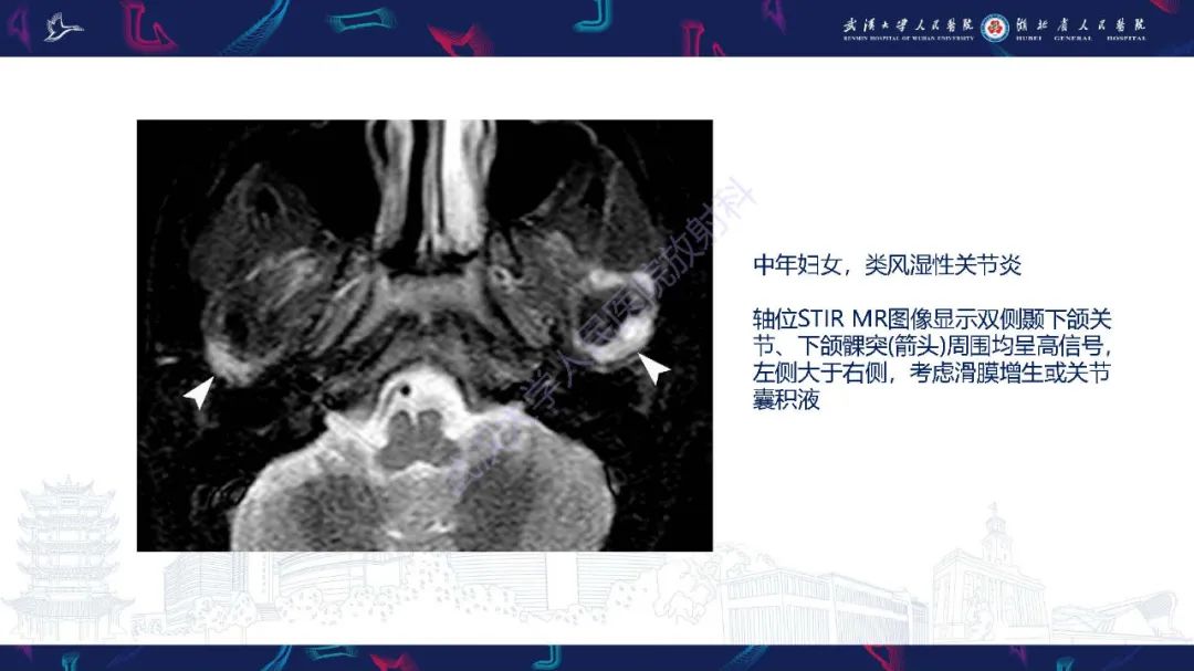 影像PPT - 【PPT】累及颅面部的系统性疾病影像诊断-83