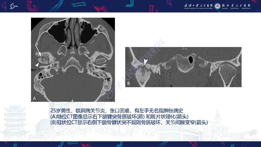 影像PPT - 【PPT】累及颅面部的系统性疾病影像诊断-86