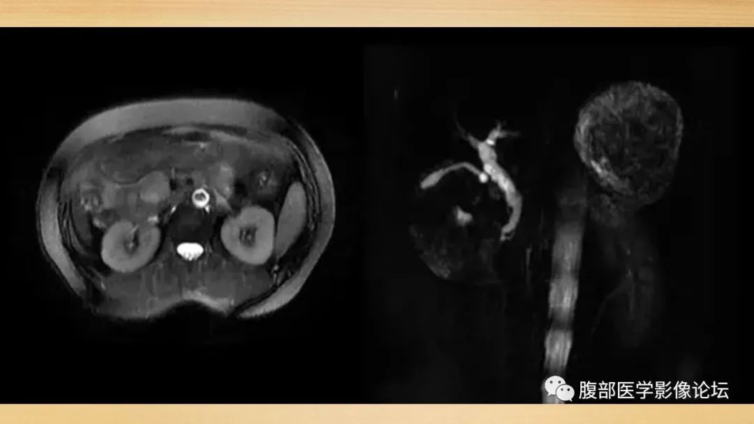 影像PPT - 【病例】胰腺副神经节瘤1例CT及MR影像-7
