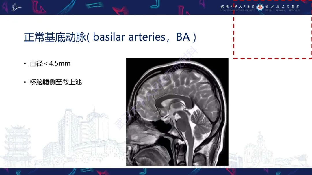 影像PPT - 【PPT】椎基底动脉扩张延长症影像诊断-6