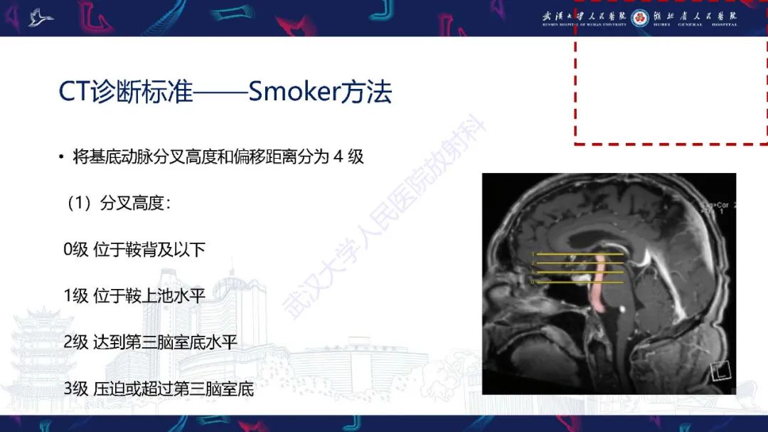 影像PPT - 【PPT】椎基底动脉扩张延长症影像诊断-7