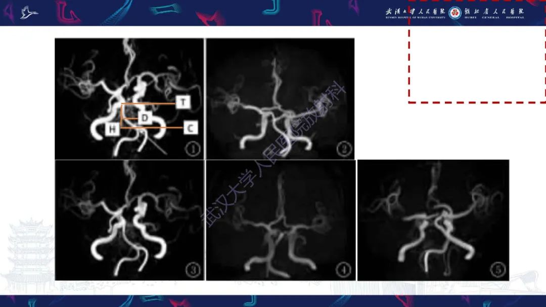 影像PPT - 【PPT】椎基底动脉扩张延长症影像诊断-13