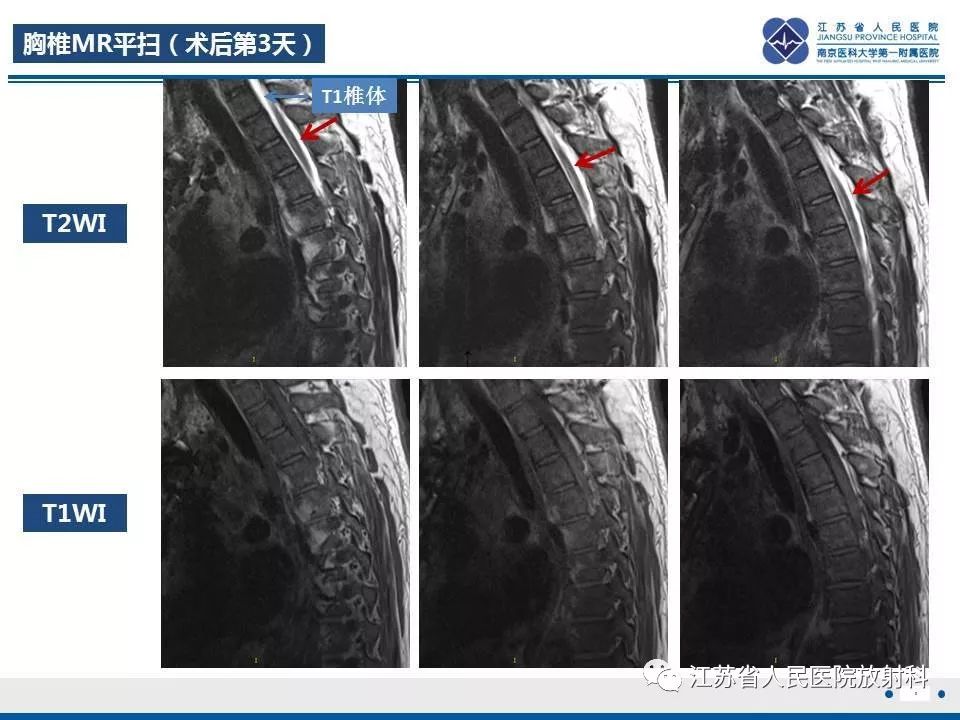 影像PPT - 【病例】脊髓梗死—脊髓前动脉综合征1例MR-3
