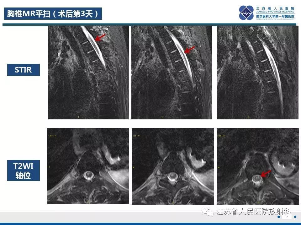 影像PPT - 【病例】脊髓梗死—脊髓前动脉综合征1例MR-4