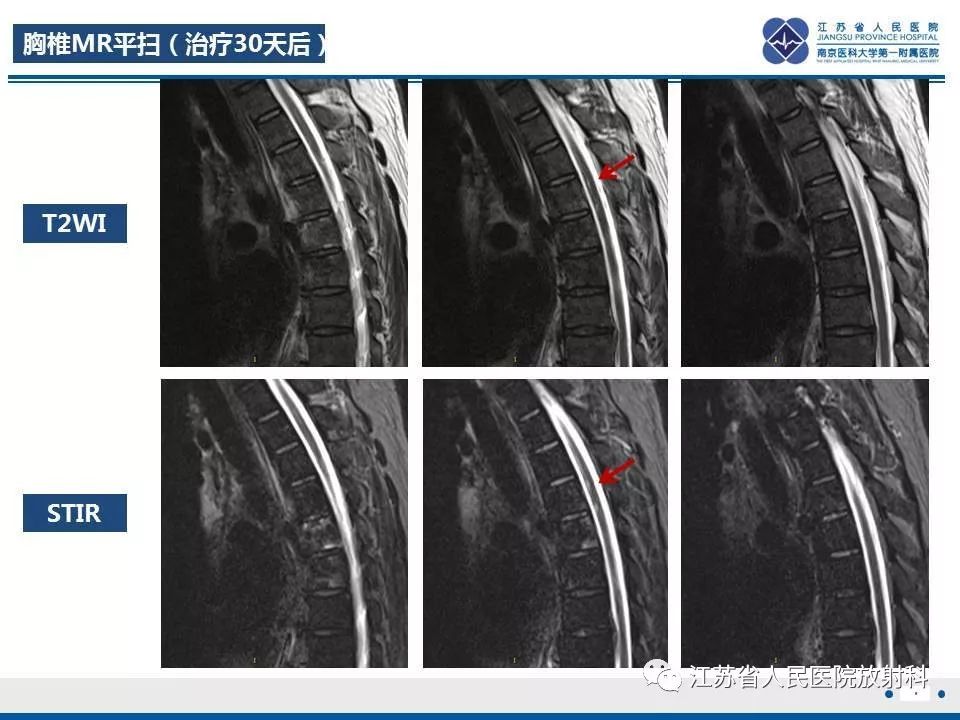 影像PPT - 【病例】脊髓梗死—脊髓前动脉综合征1例MR-5