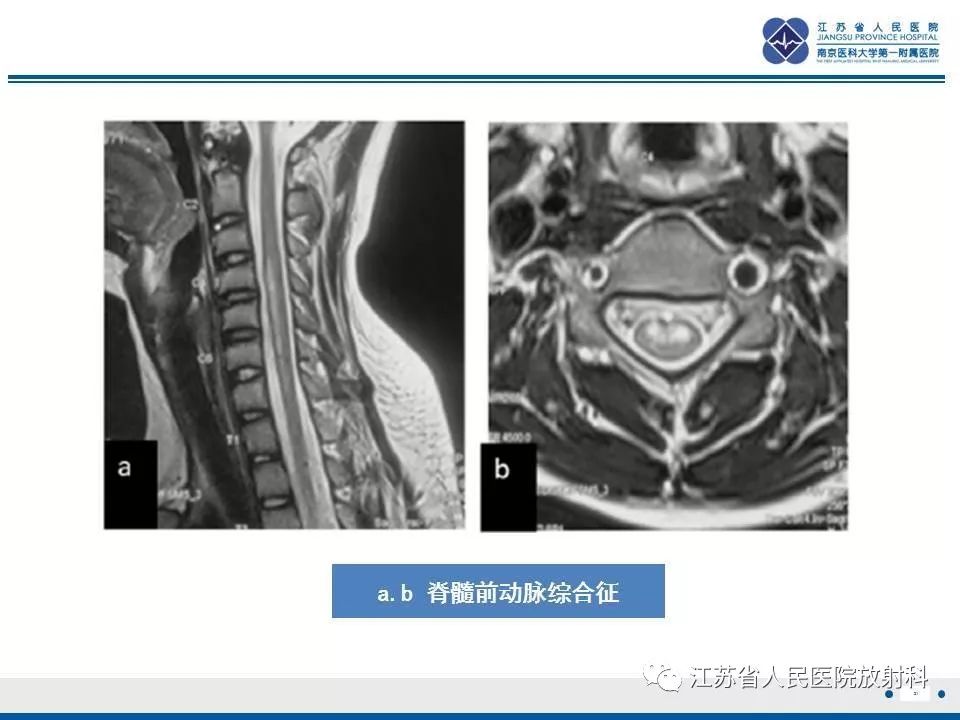 影像PPT - 【病例】脊髓梗死—脊髓前动脉综合征1例MR-21